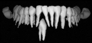 Estrazione del dente incluso